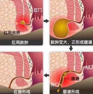 肛瘘不做手术行吗？可以自愈吗？